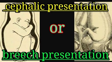 meaning of Cephalic / breech presentation baby in ultrasound report. USG read at home. - YouTube