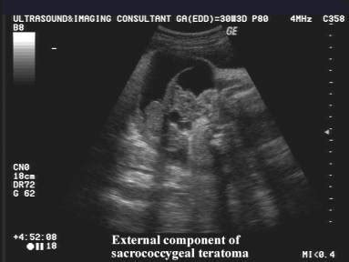 Ultrasound In Sacrococcygeal Teratoma