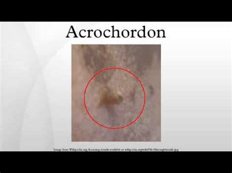 Acrochordon - YouTube