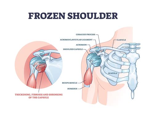 Frozen Shoulder Symptoms, Causes & Treatments | Advanced Surgery Center