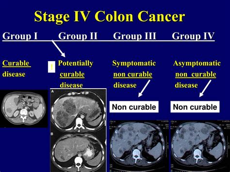 Colorectal Cancer Stages