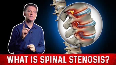 What is Spinal Stenosis And It's Causes Explained By Dr. Berg - YouTube