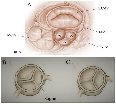 Normal Aortic Valve Anatomy