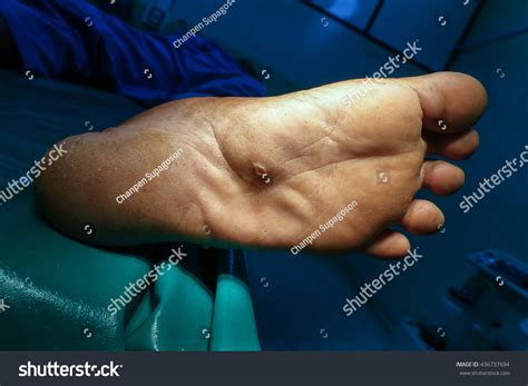 Foot Abscess Wound Pus Edema Operative Stock Photo 436737694 | Shutterstock