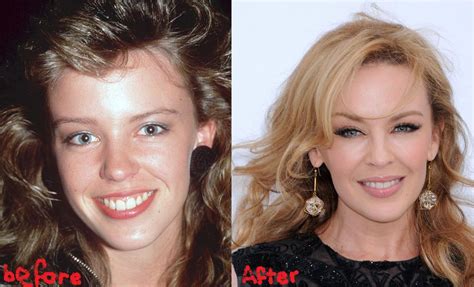 Kylie Minogue Plastic Surgery