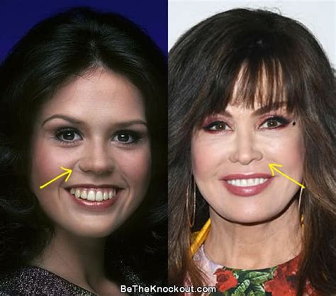 Marie Osmond Plastic Surgery Comparison Photos