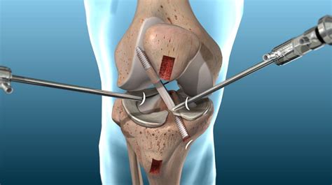 ANTERIOR CRUCIATE LIGAMENT (ACL) RECONSTRUCTION - Midwest Orthopaedics