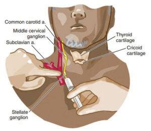 Stellate Ganglion Block for complex regional pain syndrome affecting the upper extremities ...