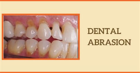 Dental Abrasion: Symptoms, Causes, Treatments