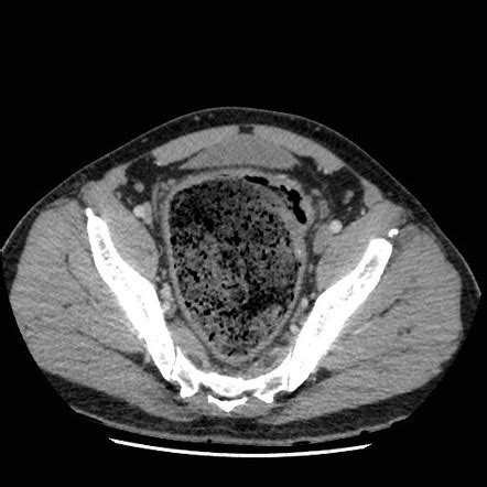 Stercoral colitis | Radiology Reference Article | Radiopaedia.org