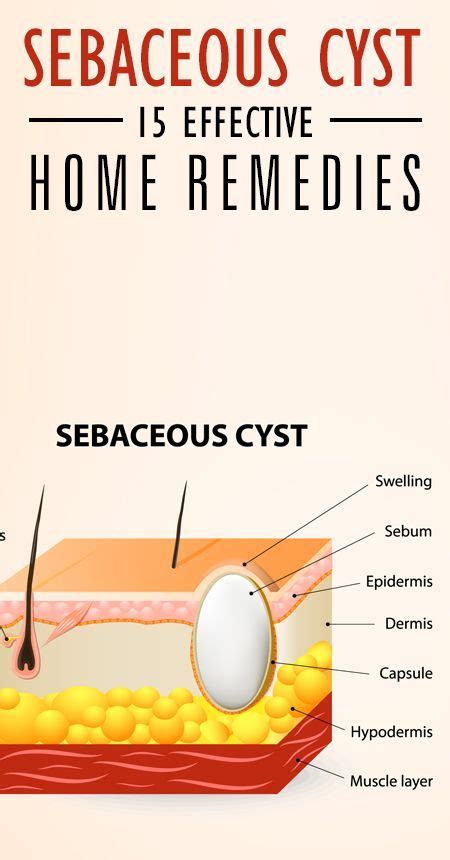 14 Home Remedies To Treat Sebaceous Cysts | Health remedies, Remedies, Holistic health