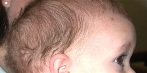 Dolichocephaly Definition, Pictures, Symptoms, Causes, Treatment