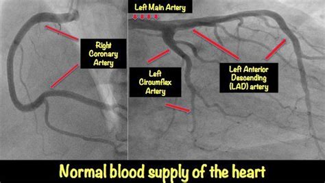 Four Major Coronary Arteries