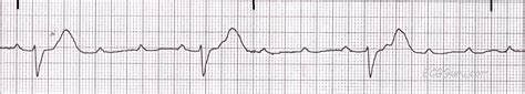 ECG Basics: Third-degree AV Block, Complete Heart Block | ECG Guru - Instructor Resources