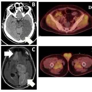 Panel A: CT angiogram shows a left ICA occlusion at the origin (White ...