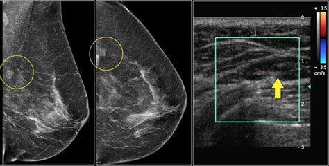 Bi Rads Ultrasound