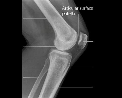 Knee lateral view x-ray (Drake, 2007) | Download Scientific Diagram