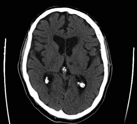 Lacunar Infarct - Definition, Symptoms, Causes and Treatment | HubPages