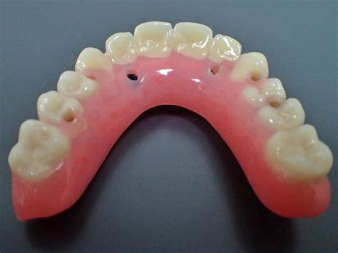 Fixed Implant Retained Hybrid Dentures - Burnham Denture Clinic in ...