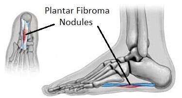 19+ Plantar Fibroma Massage - HoaiSargon