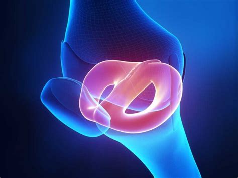 Lateral Meniscus Injuries | Lateral Meniscus Tear | Meniscus Tear Types | Orthopedic Knee ...