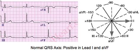 Determine Axis on a 12-lead ECG Tracing | LearntheHeart.com