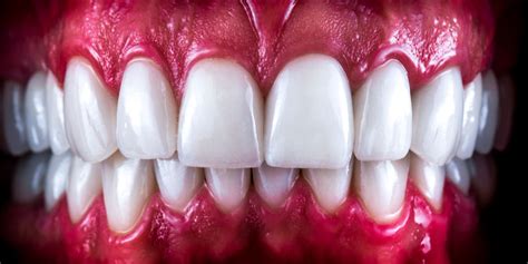 What Are Full Mouth Dental Implants? | Stuparich & Nouel Dental