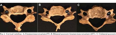 [PDF] Anatomical Variations of the Foramen Transversarium in Cervical Vertebrae | Semantic Scholar