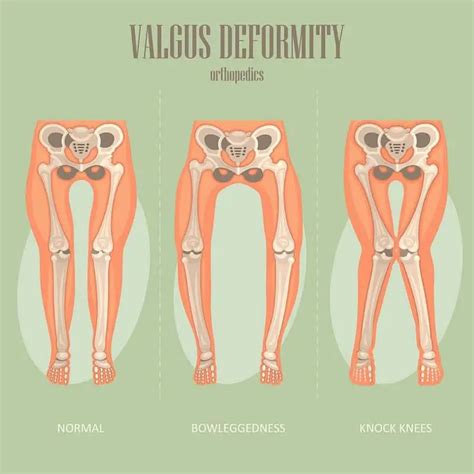 Knee Valgus: How To Fix Knock Knees - Elite Feet