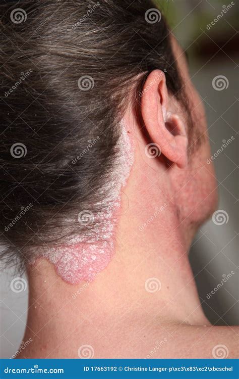 Severe Psoriasis Neck And Neck Stock Photography - Image: 17663192