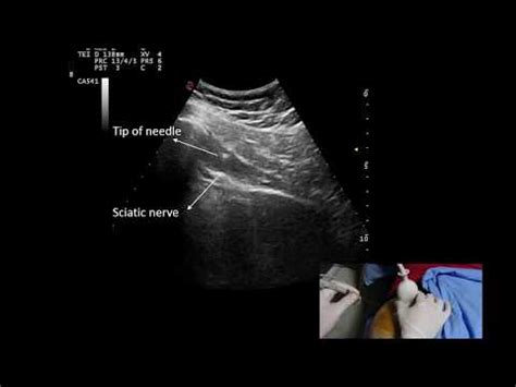 Injection For Piriformis Syndrome