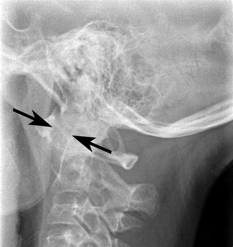 Early Atlantoaxial Subluxation in Enthesitis-related Arthritis | The Journal of Rheumatology