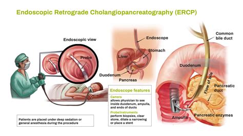 ERCP and EUS advanced endoscopy Murdoch Perth