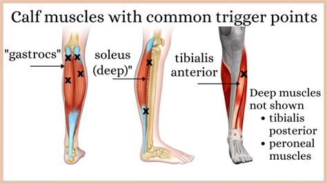 Massage and trigger point therapy for calf pain, with self help options | Massage and trigger ...