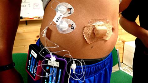 Insulin Pump And Cgm - Insulin Choices