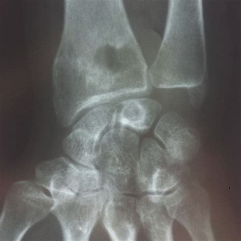 X-ray after Kuhlman’s vascularized radial bone graft. | Download ...