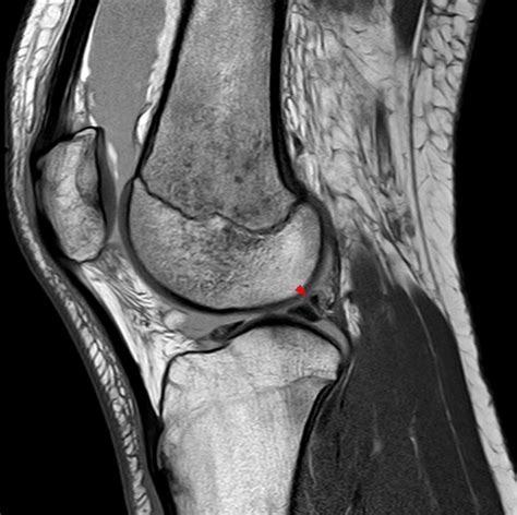 Meniscus Tear Injury Settlement Amounts | Peterson Law Offices