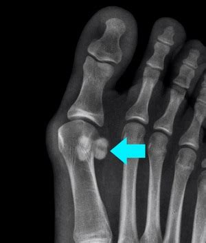 Sesamoid Fracture Overland Park | Big Toe Pain | Foot Pain Lee’s Summit MO