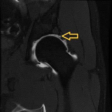 Labral Tears and FAI: A Common Cause of Hip Pain – Howard J. Luks, MD