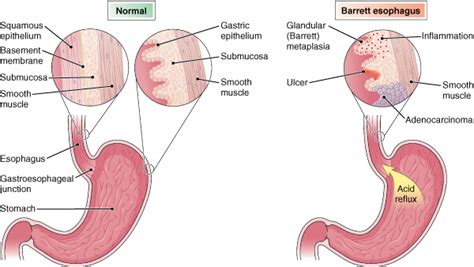 Barrett Esophagus | Diseases & Conditions | 5MinuteConsult