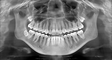 Dental X-Rays, Do I Really Need Them? - Clinique DMD