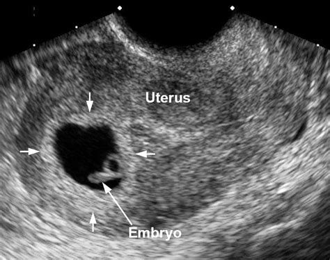 6 Week Transvaginal Ultrasound