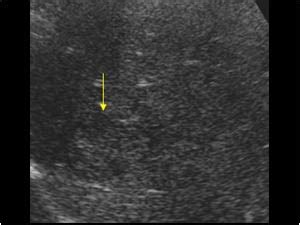 Abdomen and retroperitoneum | 1.1 Liver : Case 1.1.1 Focal nodular ...