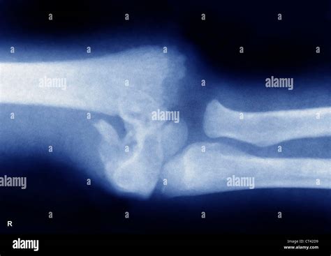 FRACTURED ELBOW, X-RAY Stock Photo - Alamy