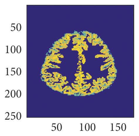 Fully automatic gray and white matter segmentation in brain MRI images ...