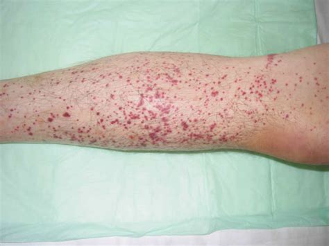 Thrombocytopenia - Causes, Signs, Symptoms, Diagnosis, Treatment