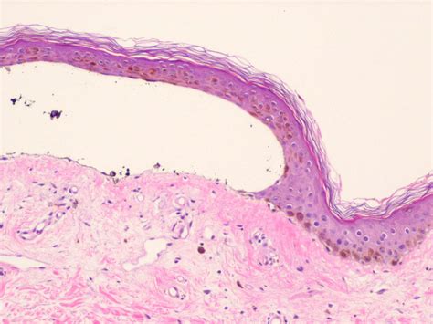 Epidermolysis Bullosa