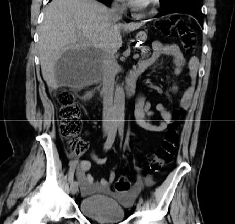 CT scan-coronal view: hypodense lesion in segment VI of the liver ...