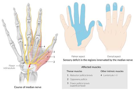 Median Nerve Palsy