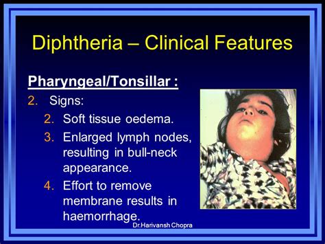 Diphtheria Bull Neck